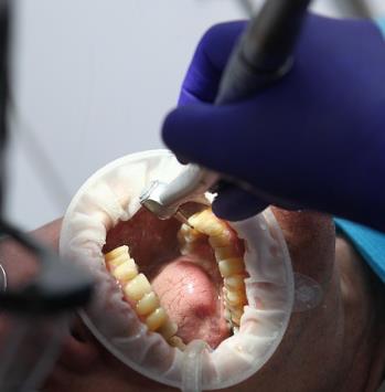 口腔微生物組：胰腺癌風險的新型生物標志物